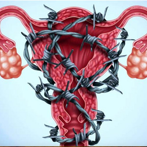 Papo Endometriótico